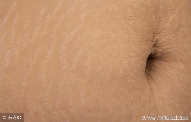 妊娠纹怎么消除?推荐4个好方法,试了不亏!