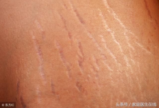 妊娠纹怎么消除?推荐4个好方法,试了不亏!