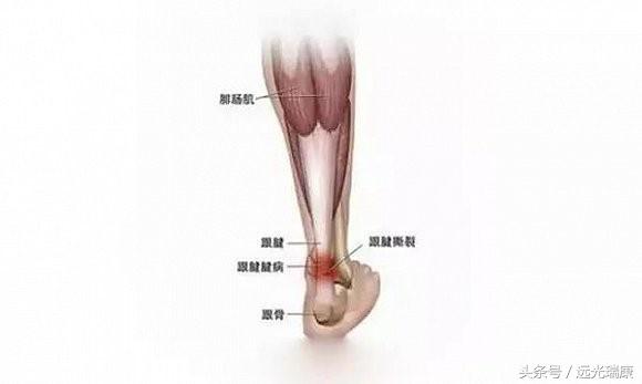 跟骨后滑囊炎痛点图图片