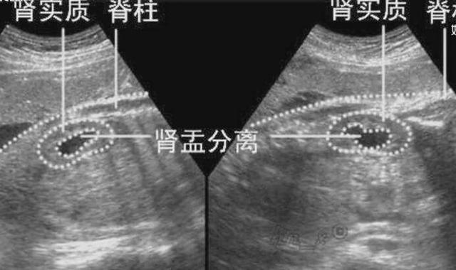 四维彩超那么贵,准妈妈要看懂,不然钱白花了!