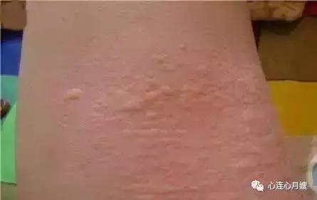 这些都不是婴儿湿疹(看图),妈妈们一定要记住!