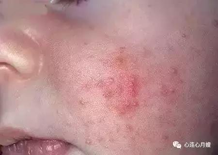 这些都不是婴儿湿疹(看图),妈妈们一定要记住!
