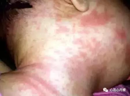 这些都不是婴儿湿疹(看图),妈妈们一定要记住!