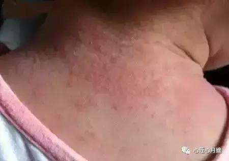 这些都不是婴儿湿疹(看图),妈妈们一定要记住!