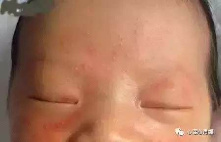 这些都不是婴儿湿疹(看图),妈妈们一定要记住!
