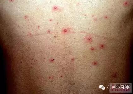 这些都不是婴儿湿疹(看图),妈妈们一定要记住!