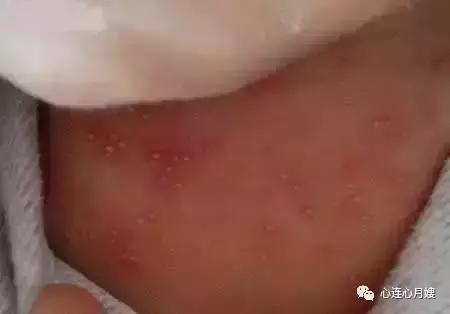 这些都不是婴儿湿疹(看图),妈妈们一定要记住!
