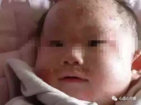 这些都不是婴儿湿疹(看图),妈妈们一定要记住!