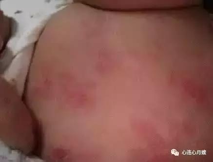 这些都不是婴儿湿疹(看图),妈妈们一定要记住!