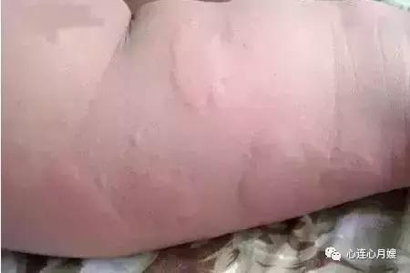这些都不是婴儿湿疹(看图),妈妈们一定要记住!