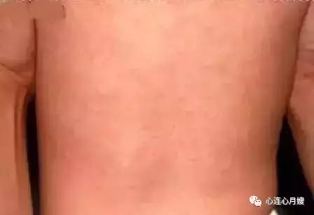 这些都不是婴儿湿疹(看图),妈妈们一定要记住!