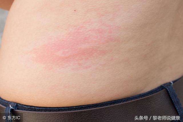 “祛痘神器”硫磺皂,你还在用吗?这3个坏处,你应该要知道!