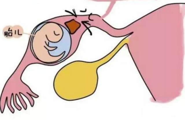 宫外孕早期有什么症状?怀孕后,这5个信号帮你“自检”宫外孕!