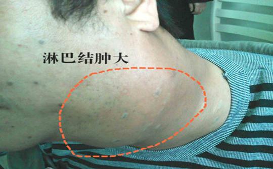 淋巴癌的早期症状有哪些？这样做可有效预防