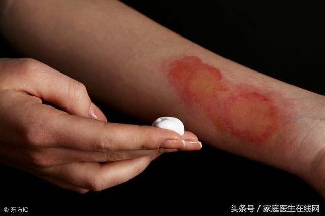 被开水烫伤该怎么办?妈妈用一急救方法,连医生都点赞,建议收藏