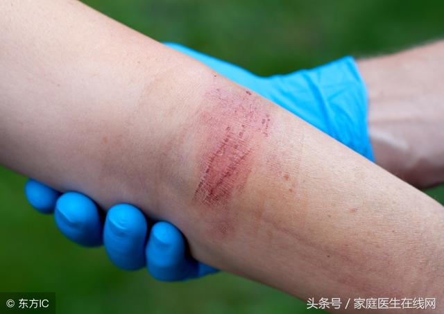 被开水烫伤该怎么办?妈妈用一急救方法,连医生都点赞,建议收藏