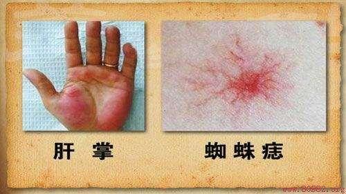 身上出现这种“小红点”,千万别忽视,可能是肝在向你求救!