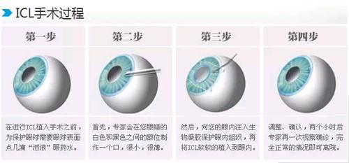 近视了怎么办?这里有3种提高裸眼视力的科学方法