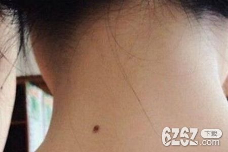 脖子后面有痣代表什么？男女脖子后面有痣命运解答